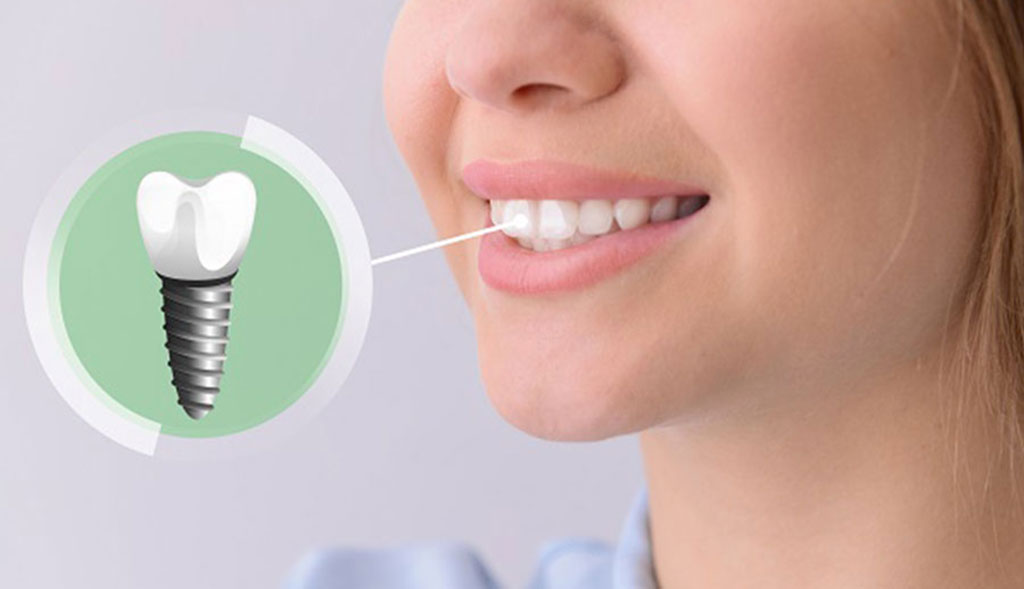 dental-implant-smile-min-1